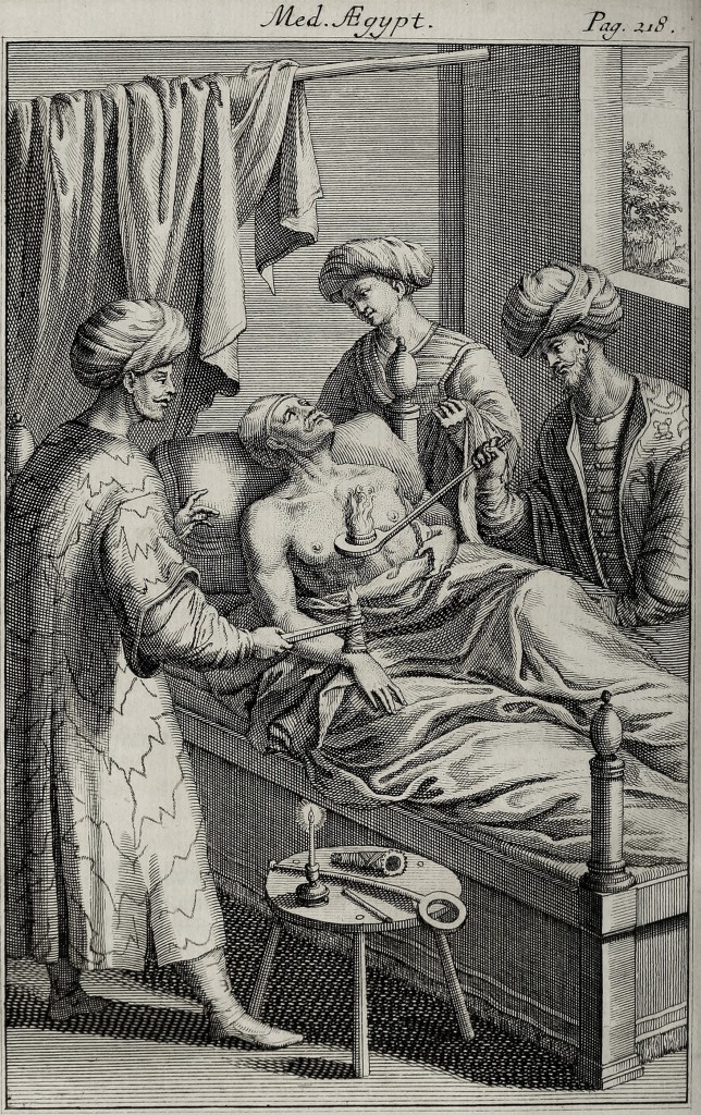 Homeopathic Cupping Therapy Illustration circa 1745 from Rosperi Alpini